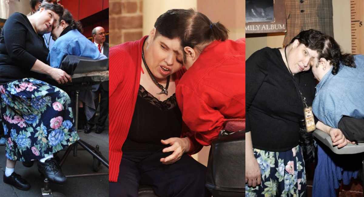 Oldest Conjoined Twins Lori George Schappell Pass Away